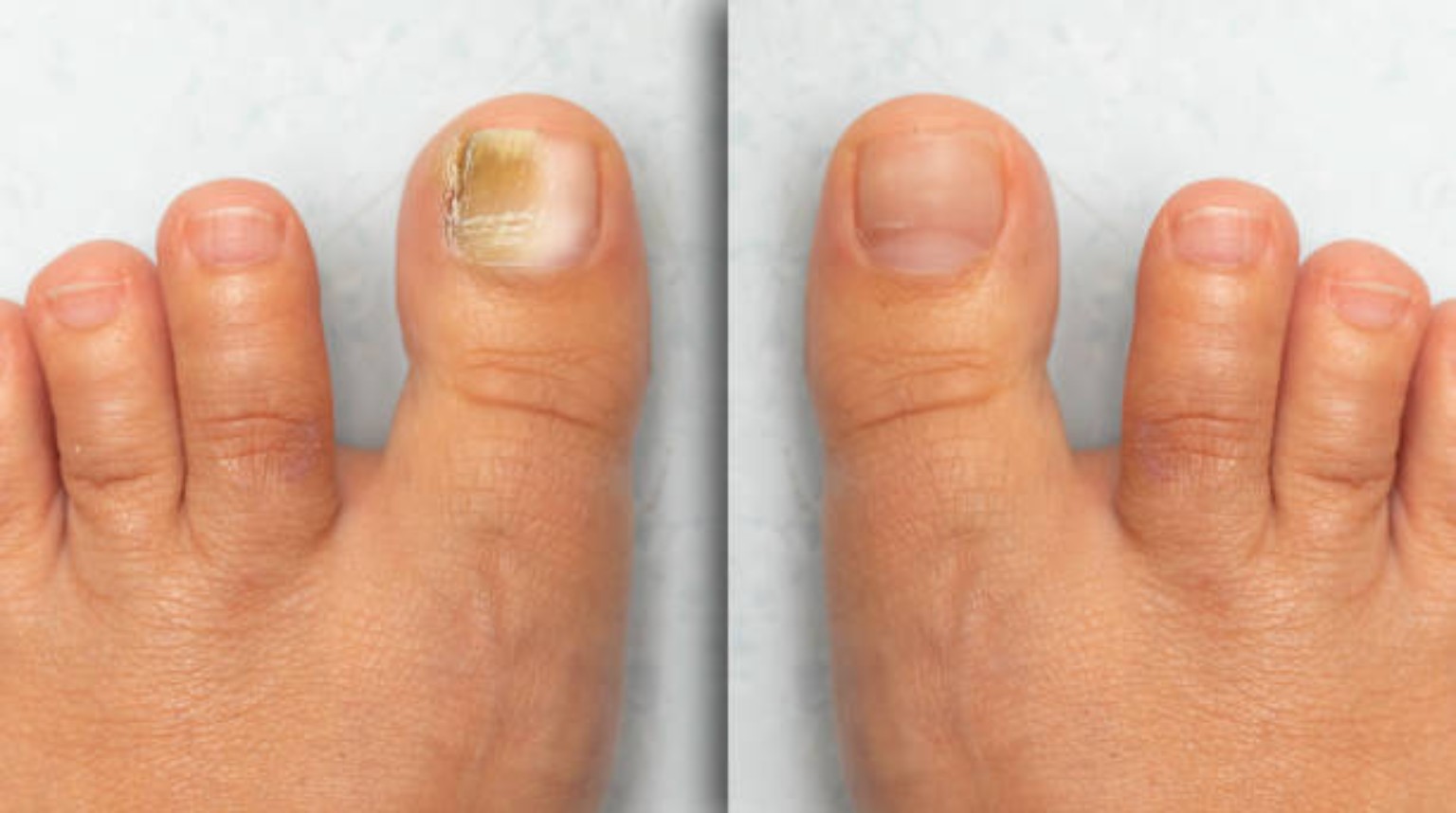 Fungal Nails guides
